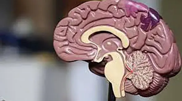 روزانه حدود 500 نفر در ایران دچار سکته های مغزی می شوند