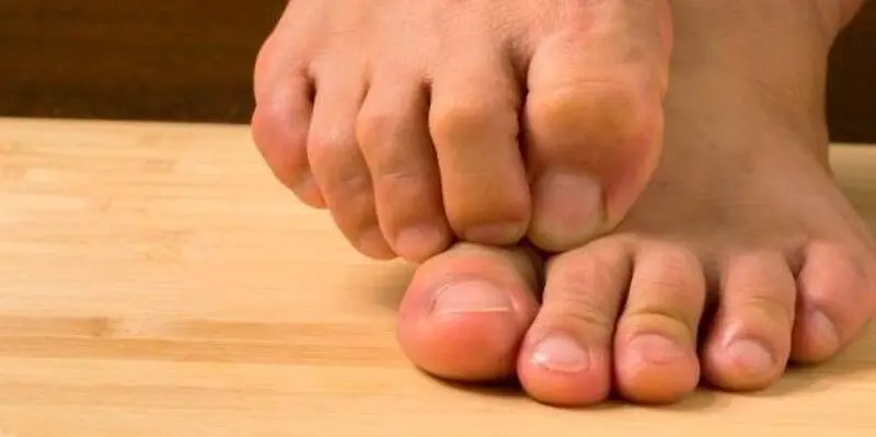 سوزش کف پا
