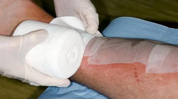 چرا سوختگی ها دیرتر درمان می شوند؟