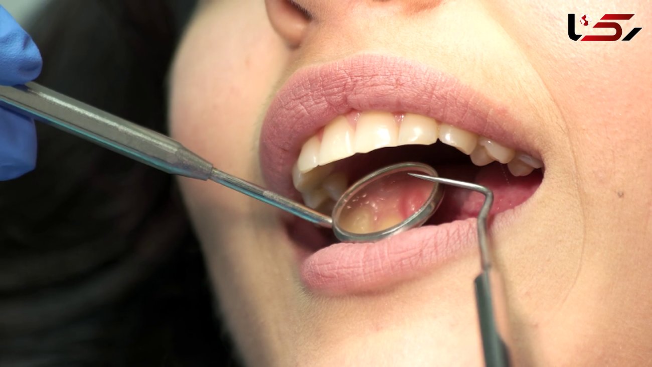 سفید کردن دندان ها با ساده ترین روش