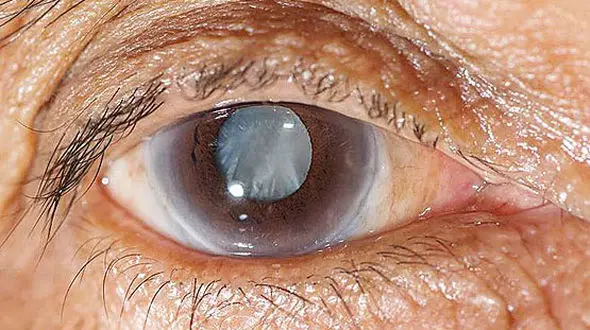 با این روش ها از ابتلای به آب مروارید پیشگیری کنید