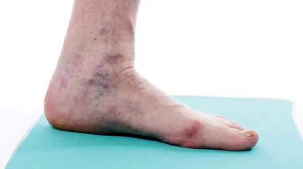 علایم هشدار دهنده از لخته خون در پاها