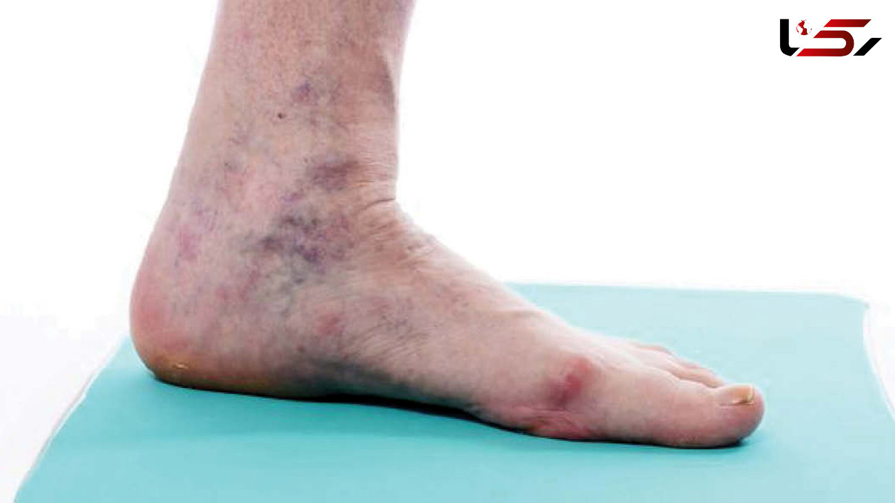 علایم هشدار دهنده از لخته خون در پاها