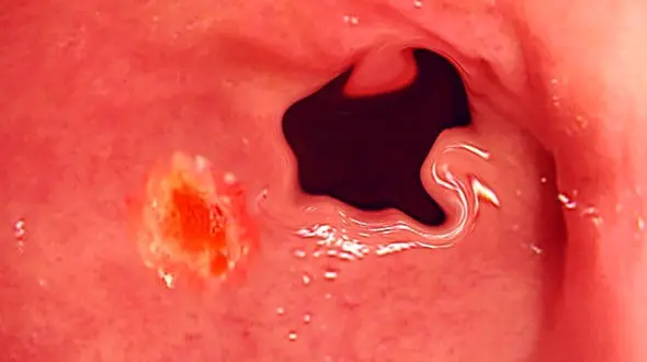 زخم اثنی عشر چیست؟ + فیلم 