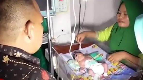 تولد انسان عجیب الخلقه  + فیلم نوزاد فضایی در اندونزی