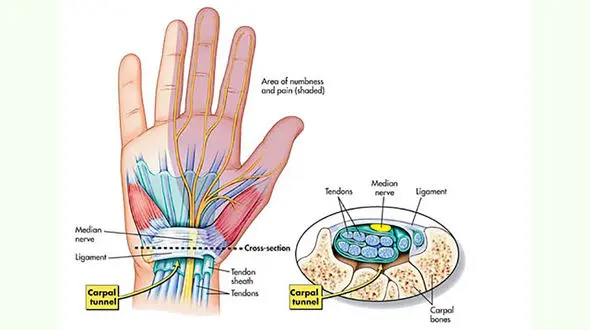 تونل کارپال چیست؟
