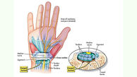 تونل کارپال چیست؟