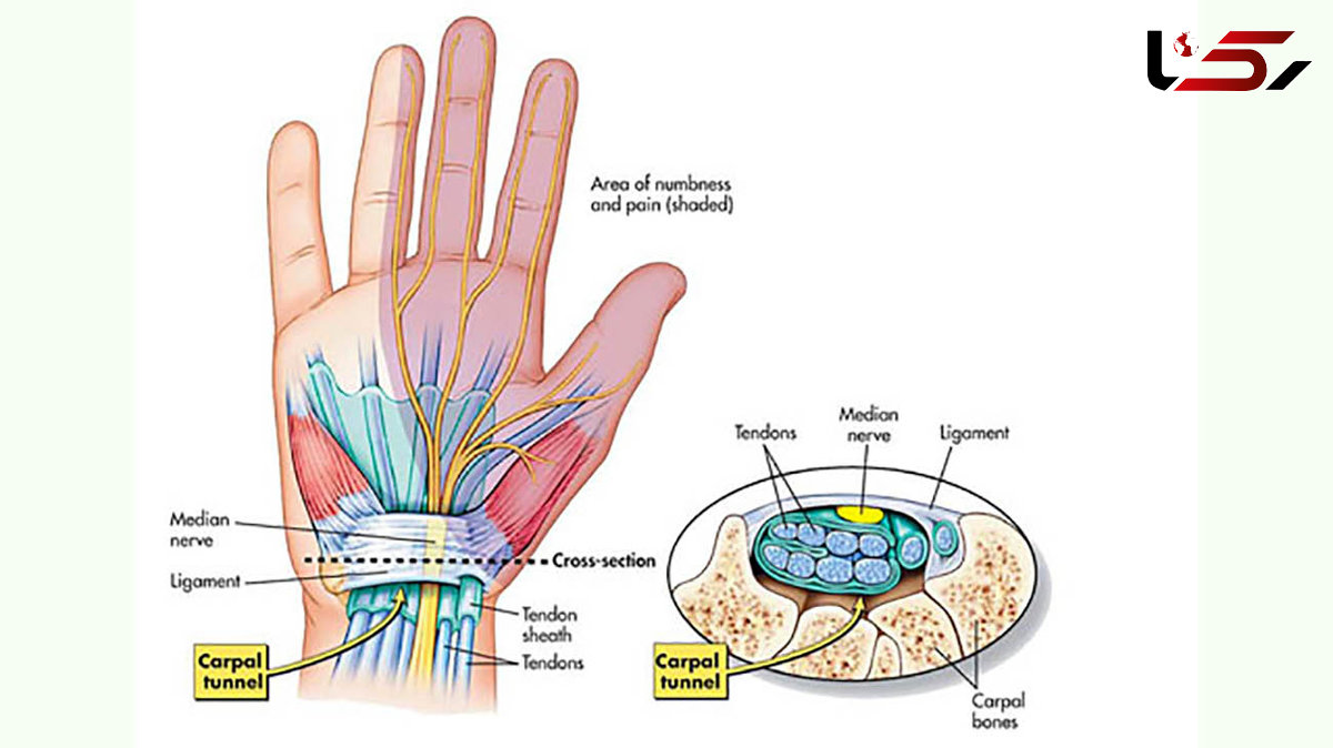 تونل کارپال چیست؟