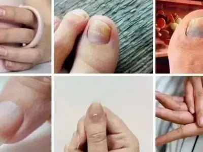مراقب باشید! 7 نشانه کلسترول بالا که ناخن‌ ها به شما هشدار می‌ دهد / پرسش و پاسخ