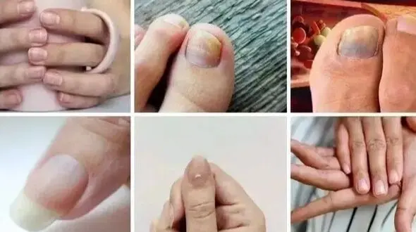 مراقب باشید! 7 نشانه کلسترول بالا که ناخن‌ ها به شما هشدار می‌ دهد / پرسش و پاسخ
