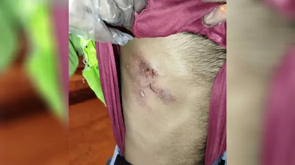 ترکیدن کیسه پر از اسید با جان پاکبان بازی کرد + جزییات