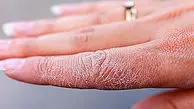 چرا پوستمان در سرما پیر و خشک می‌شود؟ رازهای نانوشته مراقبت از پوست