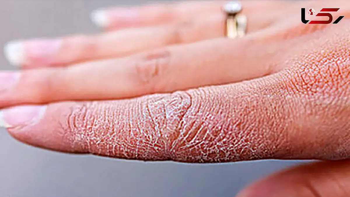 چرا پوستمان در سرما پیر و خشک می‌شود؟ رازهای نانوشته مراقبت از پوست