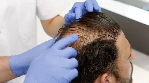 بهترین روش کاشت مو با تراکم بالا در تهران