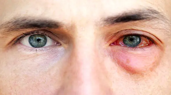 ماجرای شیوع کرونای چشمی در کشور چیست؟