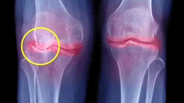 2 علامت و نشانه جدید برای مبتلایان کرونا