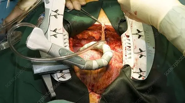 جراحی قلب و مشکلات مغزی