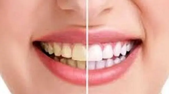 سفیدکننده‎های خانگی برای سفید کردن دندان‌ها