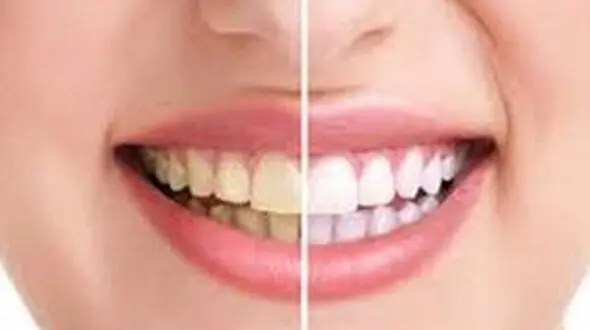 سفیدکننده‎های خانگی برای سفید کردن دندان‌ها