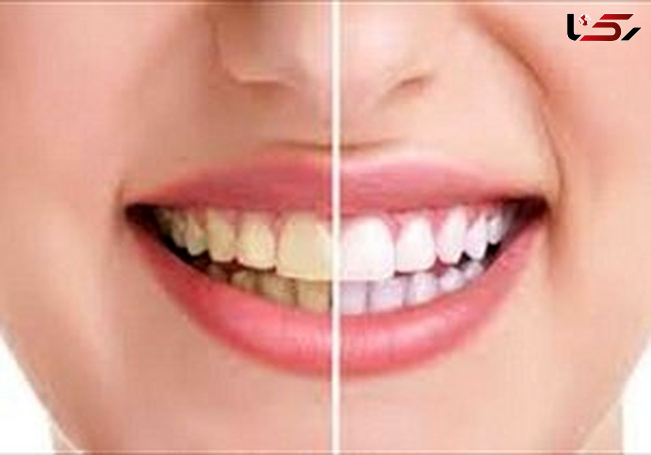 سفیدکننده‎های خانگی برای سفید کردن دندان‌ها