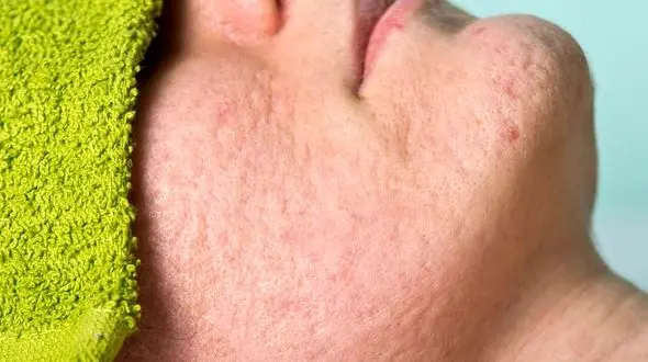 ارتباط کاهش دما و آکنه