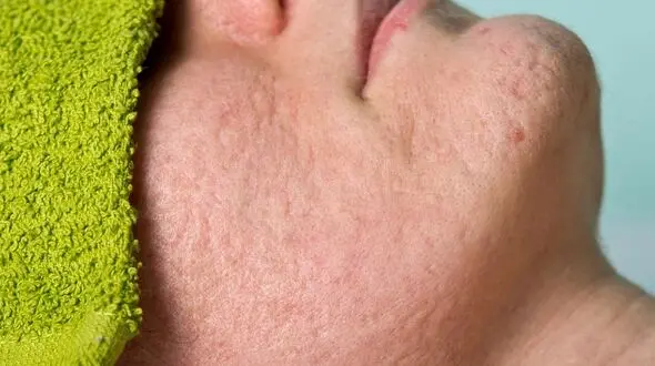 ارتباط کاهش دما و آکنه