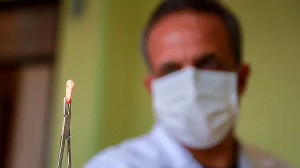 مضرات استفاده از میخک برای تسکین دندان درد/ از خلال دندان استفاده نکنید 