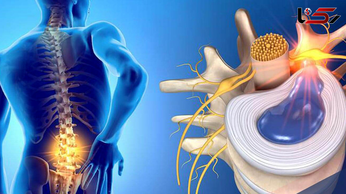علائم دیسک کمر و بهترین روش های درمان و تشخیص دیسک کمر