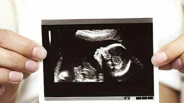 عکس عجیب جنین ، موجب وحشت زن جوان باردار شد + تصاویر 