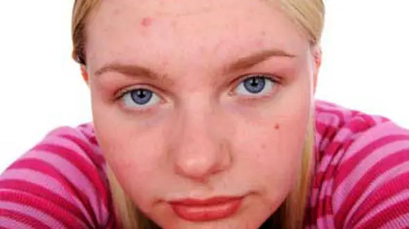 ﻿متداولترین روش ها برای  از بین بردن جای جوش صورت