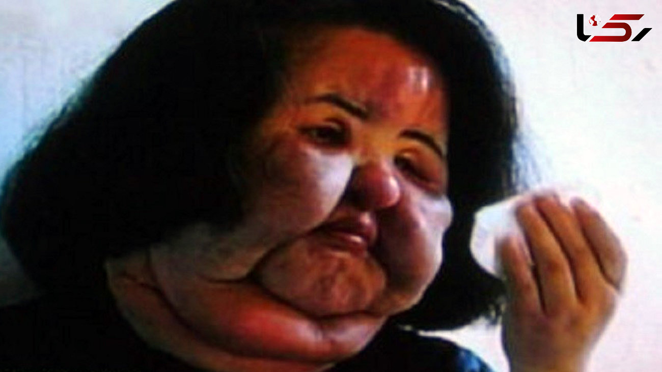 تصویر  زنی که به صورتش روغن مایع تزریق کرد!/بلای وحشتناکی که باورکردنی نیست+عکس