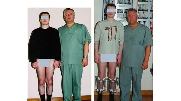 فیلم جالب از نحوه‌ی عمل جراحی افزایش قد! + عکس