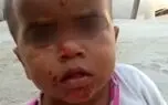 افزایش ابتلا به بیماری قارچ رنگی بین کودکان بلوچستان/ کمبود آب بهداشتی و تحریم  از علل  گسترش بیماری