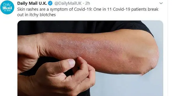 علائم جدید بیماری کرونا + عکس