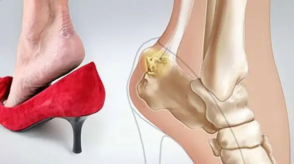 کفش پاشنه بلند قاتل اعضای بدن 