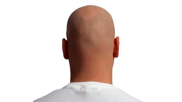کچل شدن 70 پسرجوان به خاطر عشق به یک دختر 18 ساله + عکس باورنکردنی!