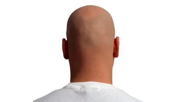 کچل شدن 70 پسرجوان به خاطر عشق به یک دختر 18 ساله + عکس باورنکردنی!