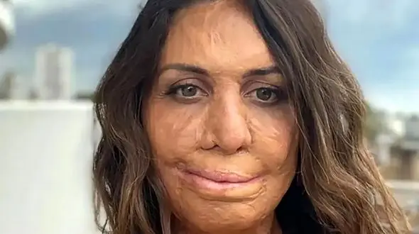 این دختر صورت سوخته لقب خوشبخت ترین زن جهان را گرفت ! + عکس ها و علت