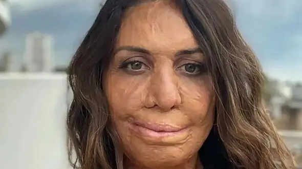 این دختر صورت سوخته لقب خوشبخت ترین زن جهان را گرفت ! + عکس ها و علت