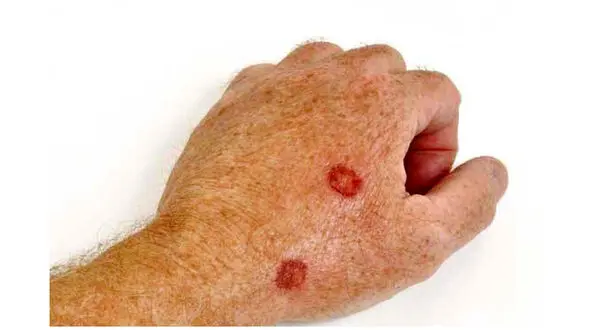 7 علامتی که زنگ خطر ابتلا به سرطان پوست هستند