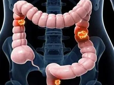 سرطان روده بزرگ: مهم ترین دلایل و پیشگیری