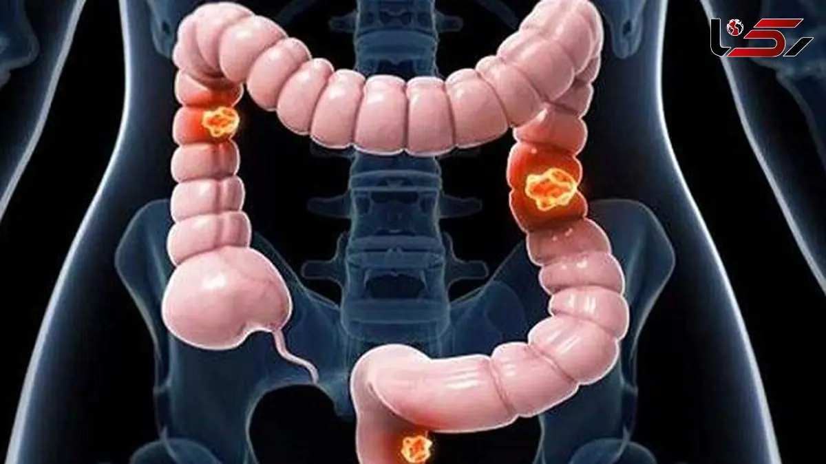 سرطان روده بزرگ: مهم ترین دلایل و پیشگیری
