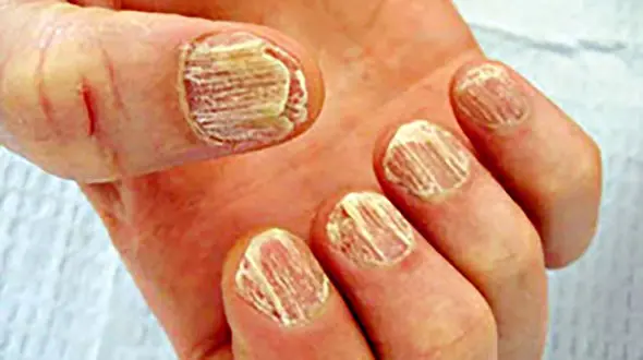 تغییر رنگ در ناخن ها چه علتی دارد؟