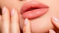 پروتز لب چیست؟ هزینه پروتز لب و مزایا و معایب آن 
