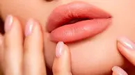 پروتز لب چیست؟ هزینه پروتز لب و مزایا و معایب آن 