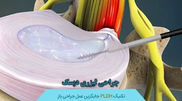  کشف نوین جراح اصفهانی در درمان دیسک با استفاده از لیزر پلاسما / بهبودی 75 درصد مبتلایان + صوت