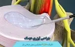  کشف نوین جراح اصفهانی در درمان دیسک با استفاده از لیزر پلاسما / بهبودی 75 درصد مبتلایان + صوت