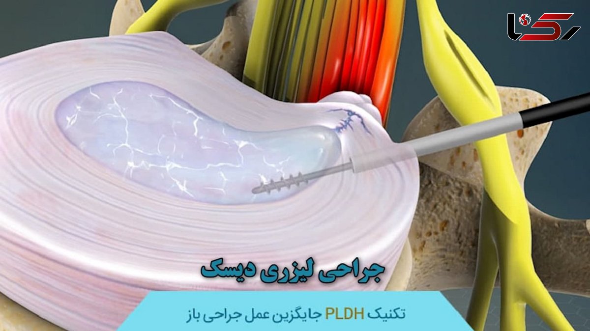  کشف نوین جراح اصفهانی در درمان دیسک با استفاده از لیزر پلاسما / بهبودی 75 درصد مبتلایان + صوت