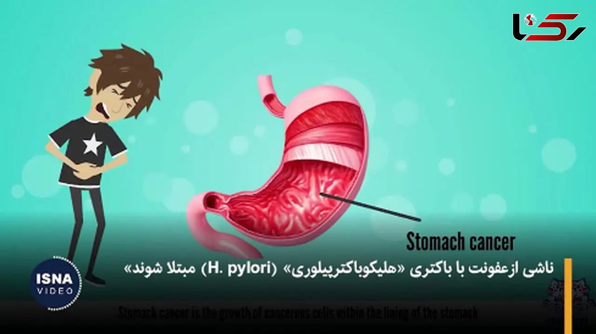 باکتری خطرناک معده: علت اصلی 12 میلیون سرطان + فیلم