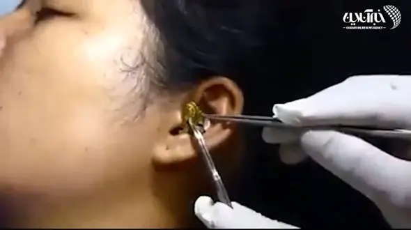 ببینید / لحظه باورنکردنی خارج کردن یک مار از گوش یک دختر جوان+ فیلم